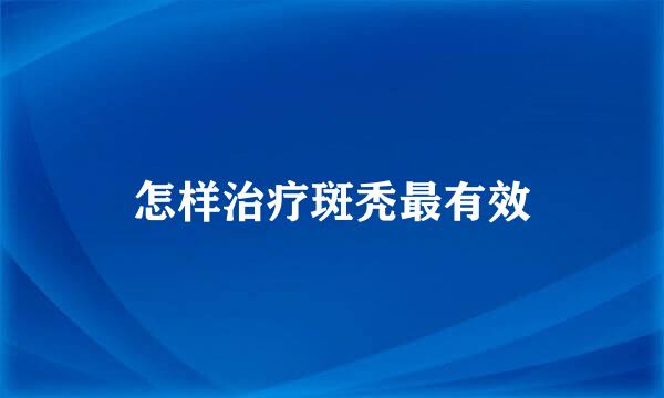 怎样治疗斑秃最有效