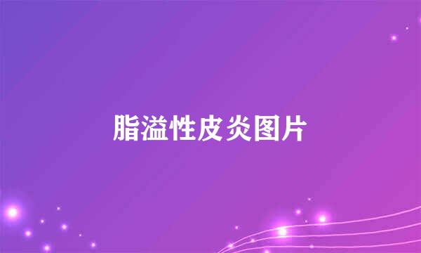 脂溢性皮炎图片