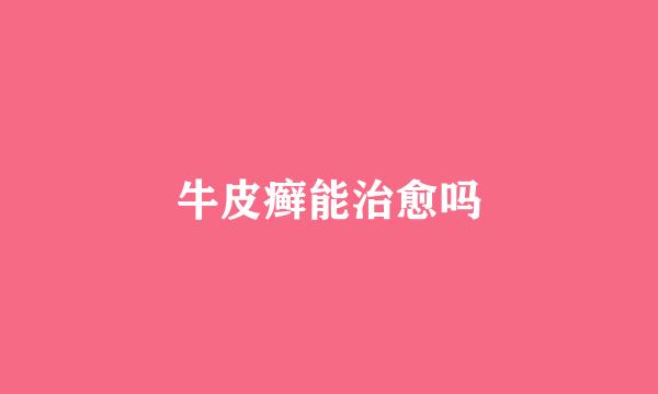 牛皮癣能治愈吗